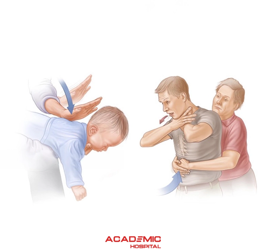 Boğulma durumunda ilk yardım[Heimlich Manevrası]