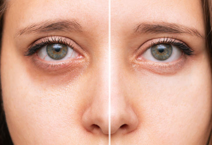 Düzenli kullanınca göz altı morluklarını ve şişliklerini yok ediyor! TikTok'ta trend olan tek malzemeli göz altı maskesi tarifi